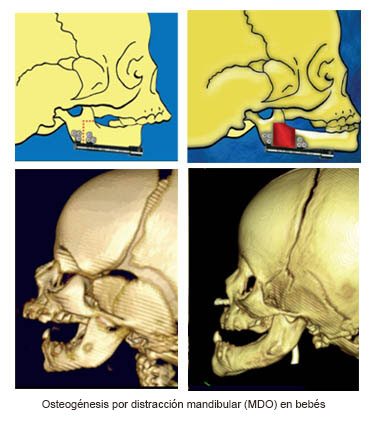 https://diningdazzle.store/SiteCollectionImages/Infant_Mandibular_Distraction_Osteogenesis_es.jpg
