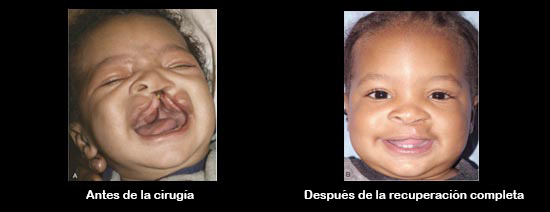 https://diningdazzle.store/SiteCollectionImagesArticleImages/CleftbeforeAfter_Baby_es.jpg