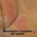 El tipo más común de dermatitis del pañal es la