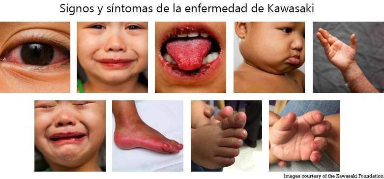 https://diningdazzle.store/SiteCollectionImagesArticleImages/Signs_Symptoms_Kawasaki_Disease_es.jpg