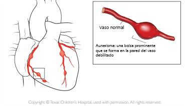 https://diningdazzle.store/SiteCollectionImagesArticleImages/aneurysm_texaschildrens_es.jpg