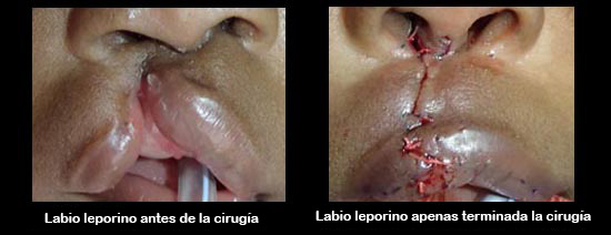 https://diningdazzle.store/SiteCollectionImagesArticleImages/cleftLipBeforeAfter2_es.jpg